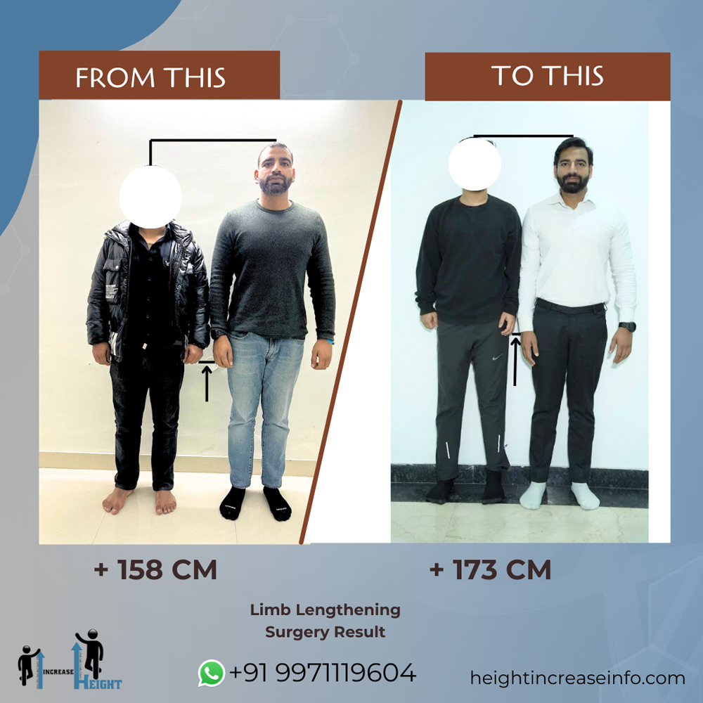 Limb Lengthening Result 1